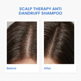 SCALP THERAPY ANTI-DANDRUFF SHAMPOO  (240ML)